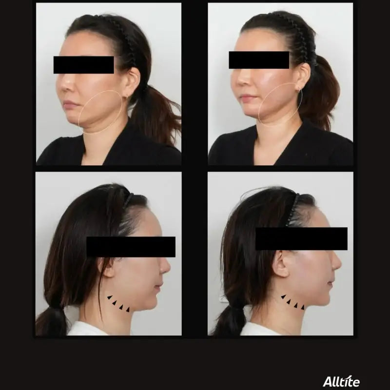 ALLTITE提升