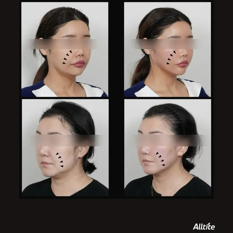 ALLTITE提升